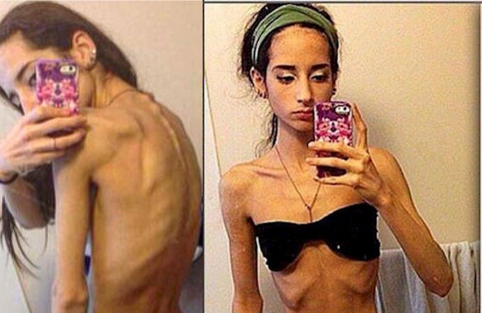 Neuveriteľná premena mladého dievčaťa. Z anorektičky na sexi fitnesku!