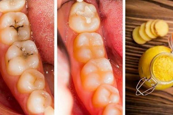 Trpíte bolesťami zubov? Predíďte im vďaka nasledujúcim potravinám, ktoré nájdete doma