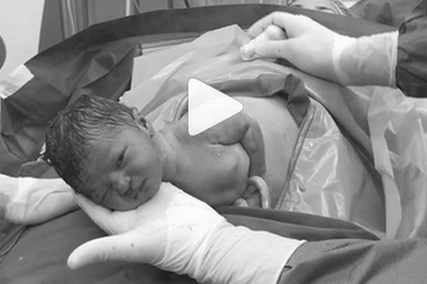 Doktor natočil video, ako vyzerá pôrod cisárskym rezom! Trúfnete si, pozrieť si ho?