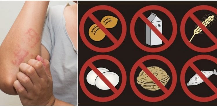 Alergia na jedlo: 4 rady, ako ju bez námahy zvládnete aj počas cestovania